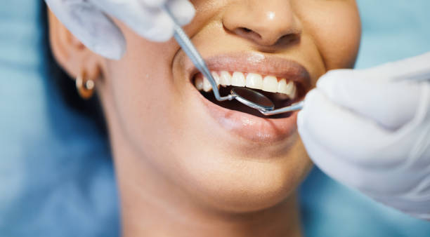 Best Knocked-Out Tooth (Avulsed Tooth) Treatment in Dolton, IL